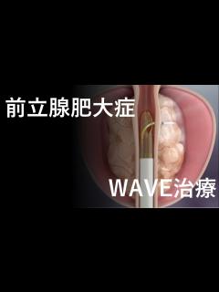 [x]【前立腺肥大症】最新治療！ WAVE治療！！ - YouTube
