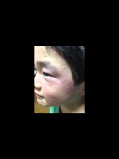 [x]寒冷蕁麻疹 Cold Urticaria 総一 Movie - YouTube